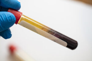 platelet rich plasma for knee osteoarthritis